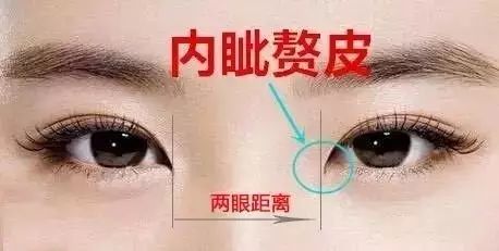 开眼角手术效果，重塑美丽双眸的秘密武器
