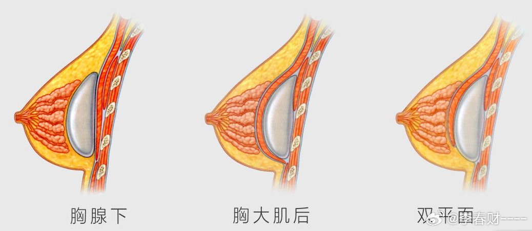 美容隆胸费用详解，价格因素与选择考量