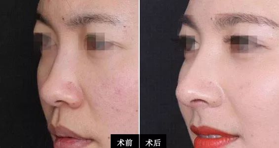 自体软骨隆鼻价格，全面解析与指导