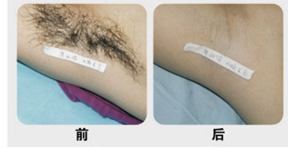激光脱毛，美丽之选，优雅之道的体现