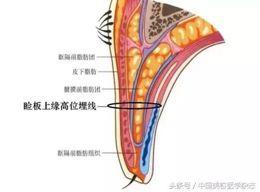 高分子埋线双眼皮的价格解析