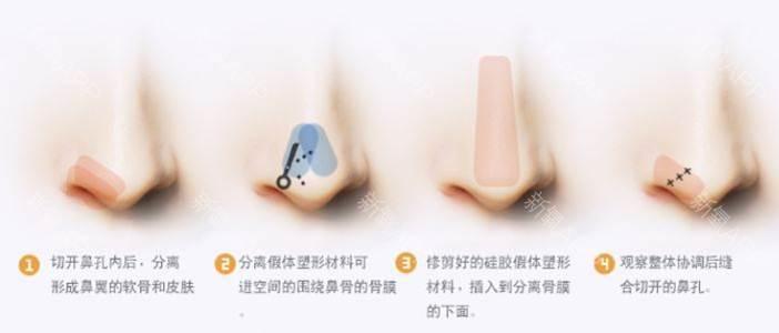 鼻尖手术价格详解，费用构成与影响因素分析