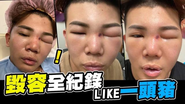假体隆鼻的优势，重塑美丽鼻梁的优选方案