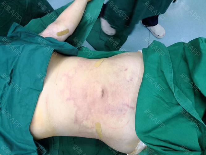 腰部吸脂手术费用详解，多少钱才能实现完美曲线？