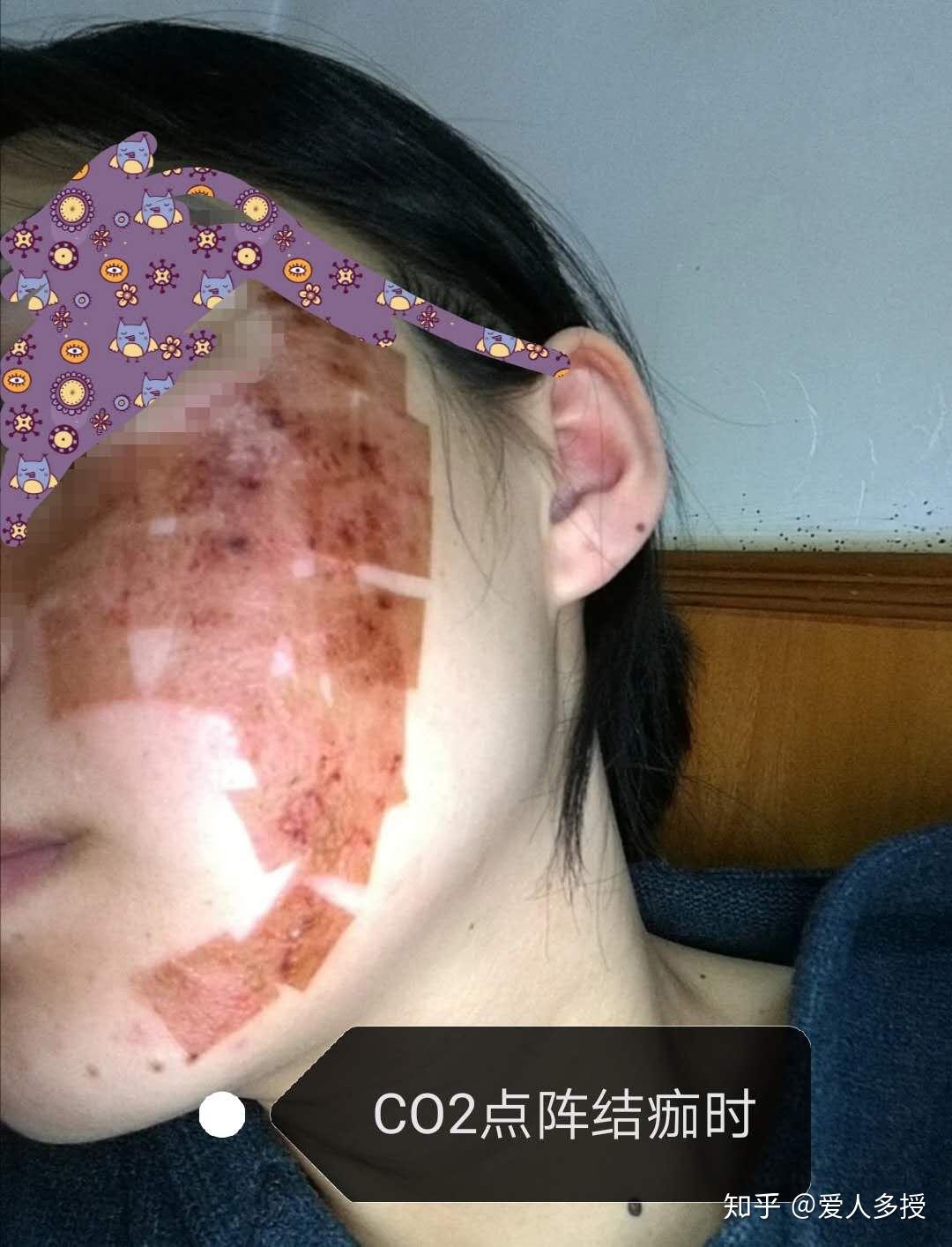 像素激光去痘坑的深度解析