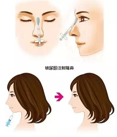 玻尿酸丰下巴，重塑美丽轮廓的时尚之选