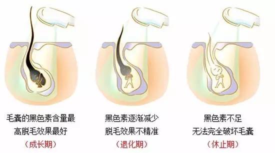 激光脱毛价格，全面解析费用因素与选择策略