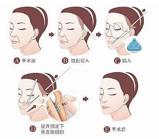 肌肤年轻化
