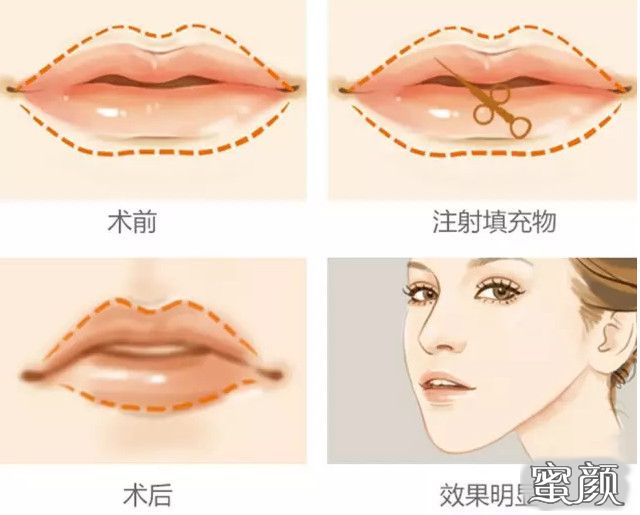 玻尿酸丰唇整形手术，重塑唇部魅力