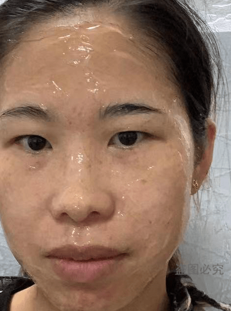 激光美容祛斑，价格与价值的平衡