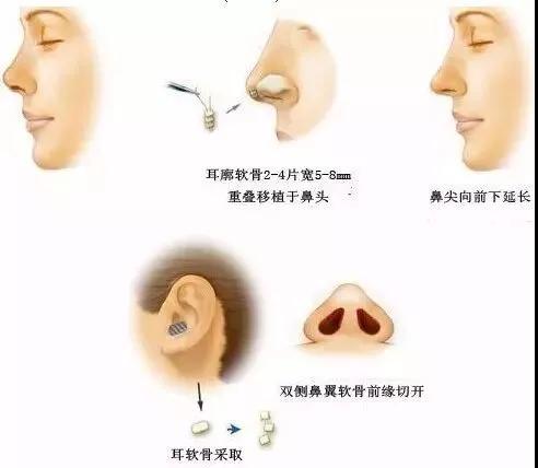 耳软骨隆鼻手术费用详解，了解耳软骨隆鼻的价格因素