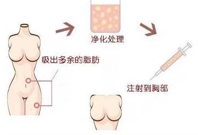 脂肪移植隆胸，重塑女性魅力的新选择