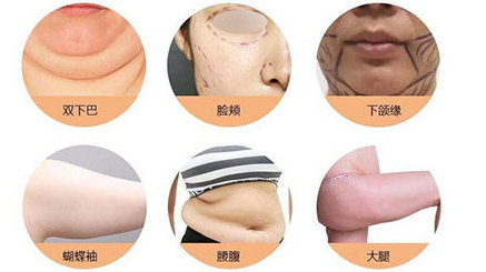 激光溶脂价格解析，成本与效果之间的权衡