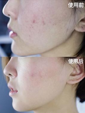 光子嫩肤的价格及其影响因素详解