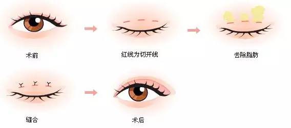 双眼皮的魅力，割双眼皮的决策与体验