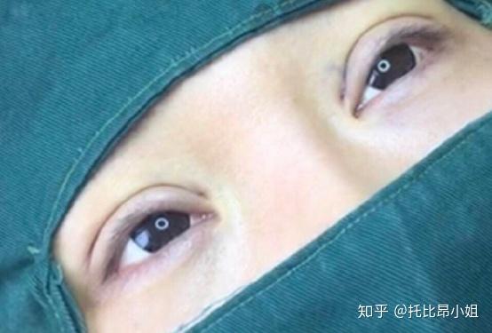 割双眼皮费用