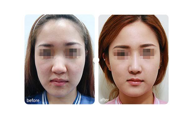 脸部整形需要多少钱？全面解析脸部整形的费用因素