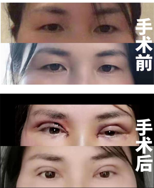 双眼皮手术费用全解析，了解割双眼皮的价格因素