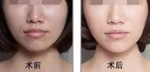 光子嫩肤的价格及其影响因素详解