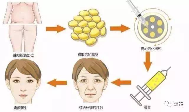 全面部自体脂肪填充，重塑美丽轮廓的先进方法