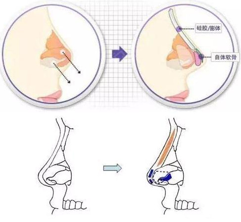 自体软骨隆鼻，价格与价值的完美融合
