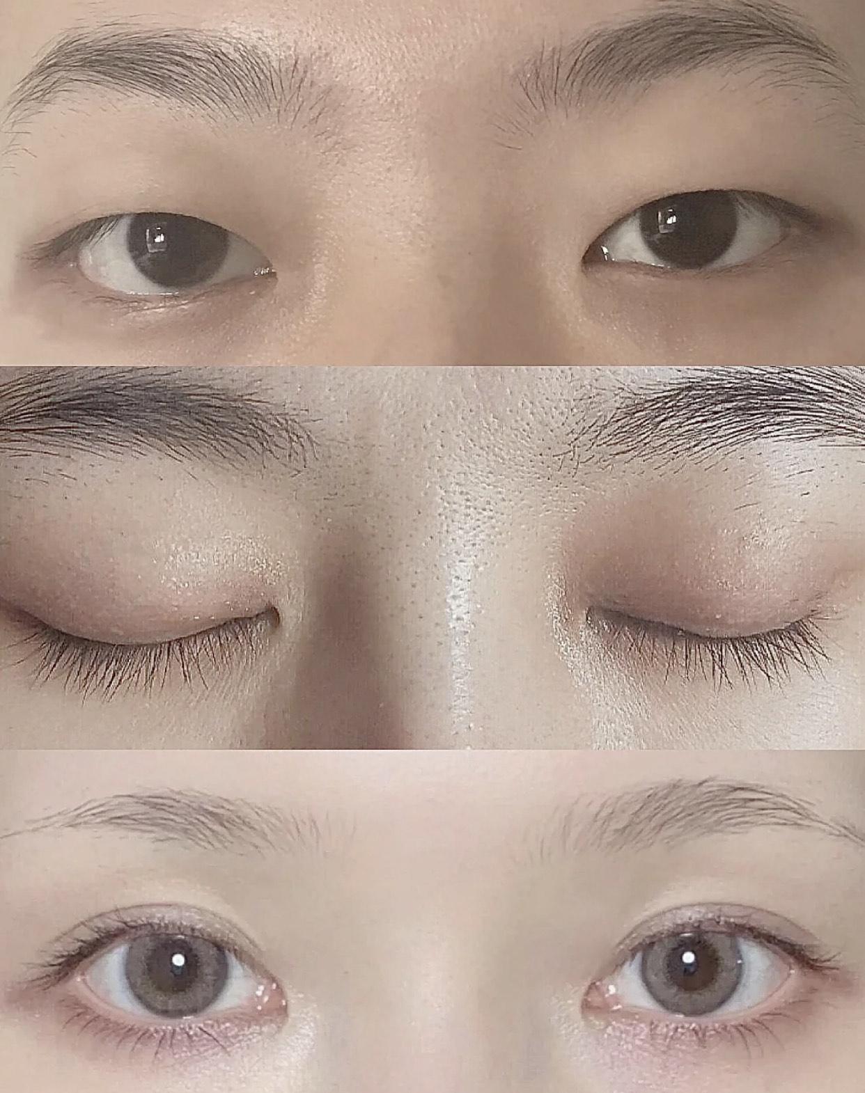 埋线双眼皮