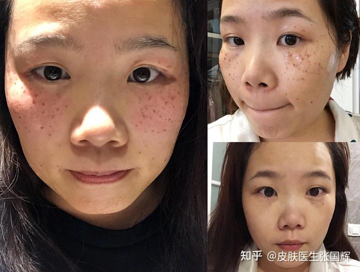 激光祛斑需要多少钱，全面解析祛斑费用与影响因素