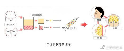 自体脂肪隆胸整形手术价格详解