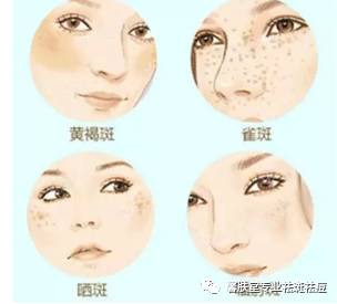 祛斑手术费用详解，价格、因素与选择