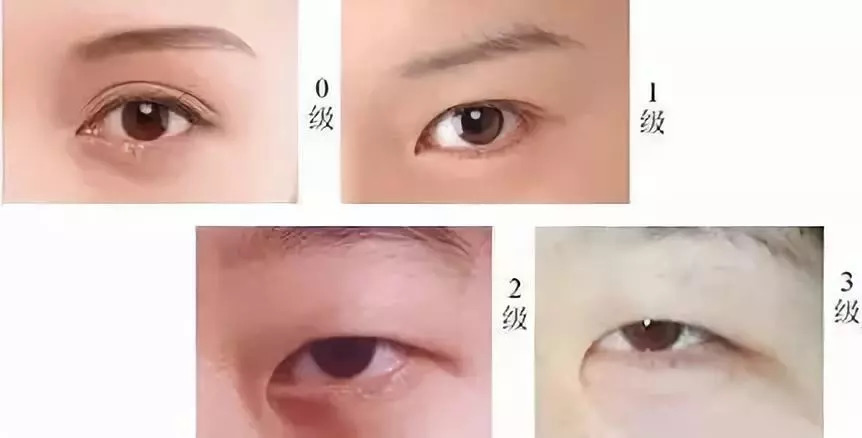 开眼角手术前后的对比与体验