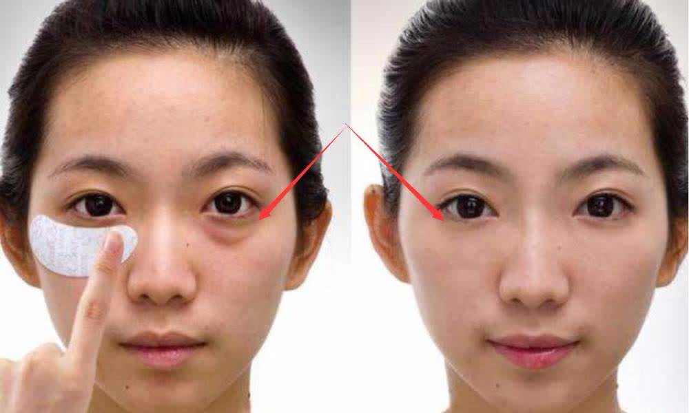 眼部除皱需要多少钱？全面解析眼部除皱费用因素