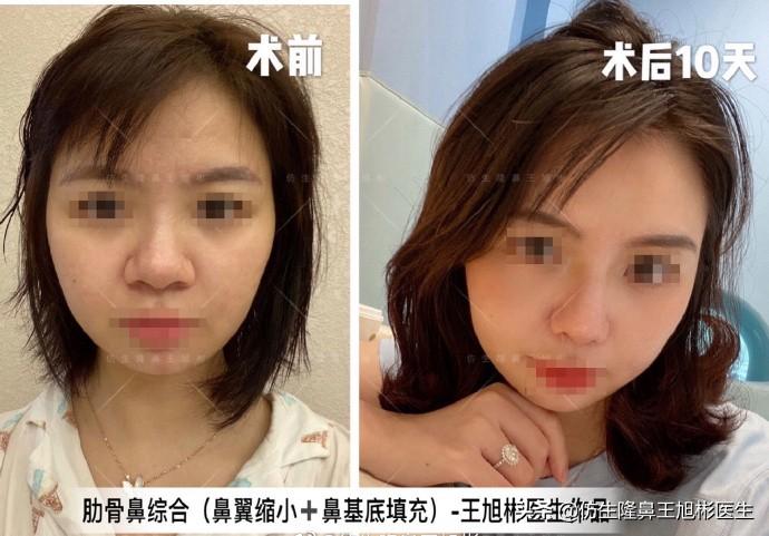 鼻尖缩小整形的魅力与重要性