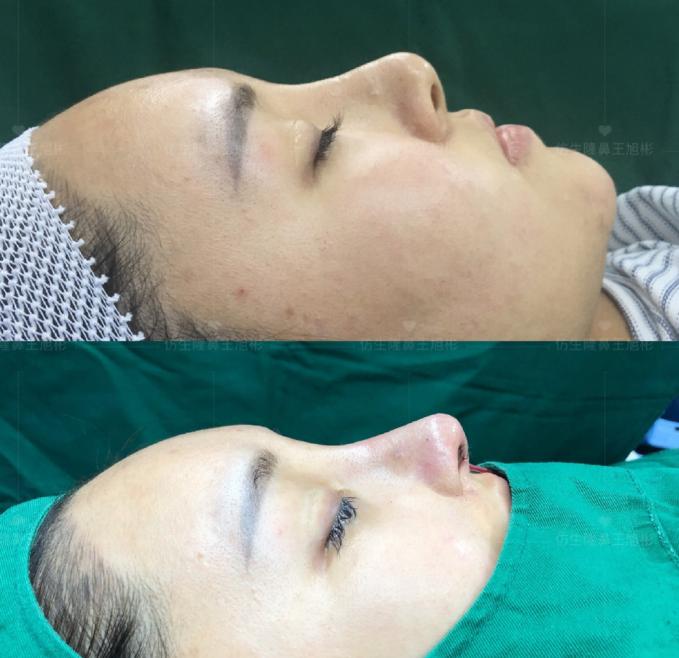 鼻翼缩小整容，重塑面部轮廓的美丽革命