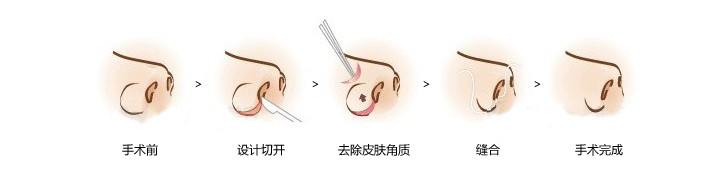 缩鼻翼手术，重塑美丽鼻型的艺术与科学