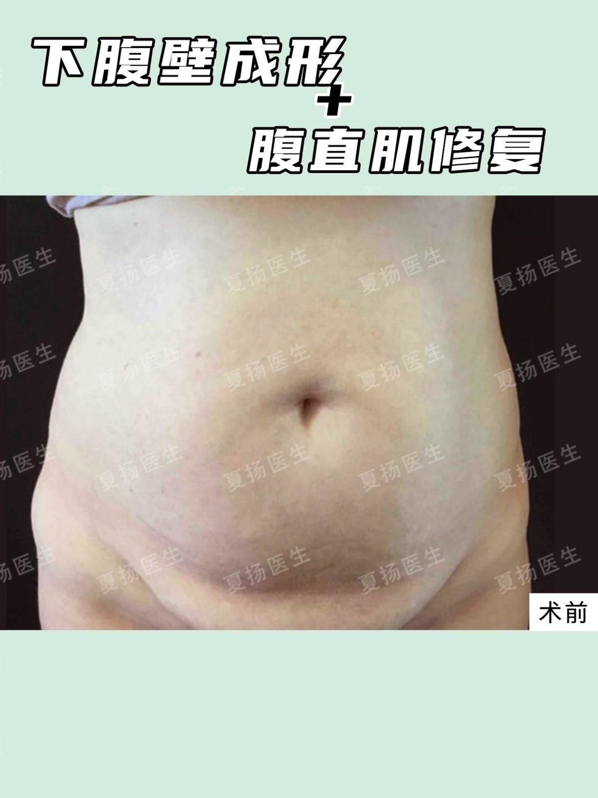 吸脂整容，现代审美下的新选择