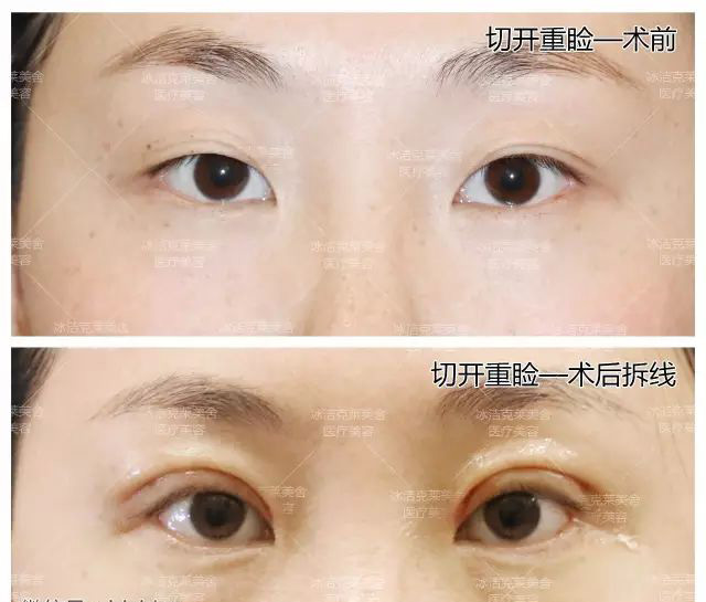 开眼角失败，手术风险与应对策略
