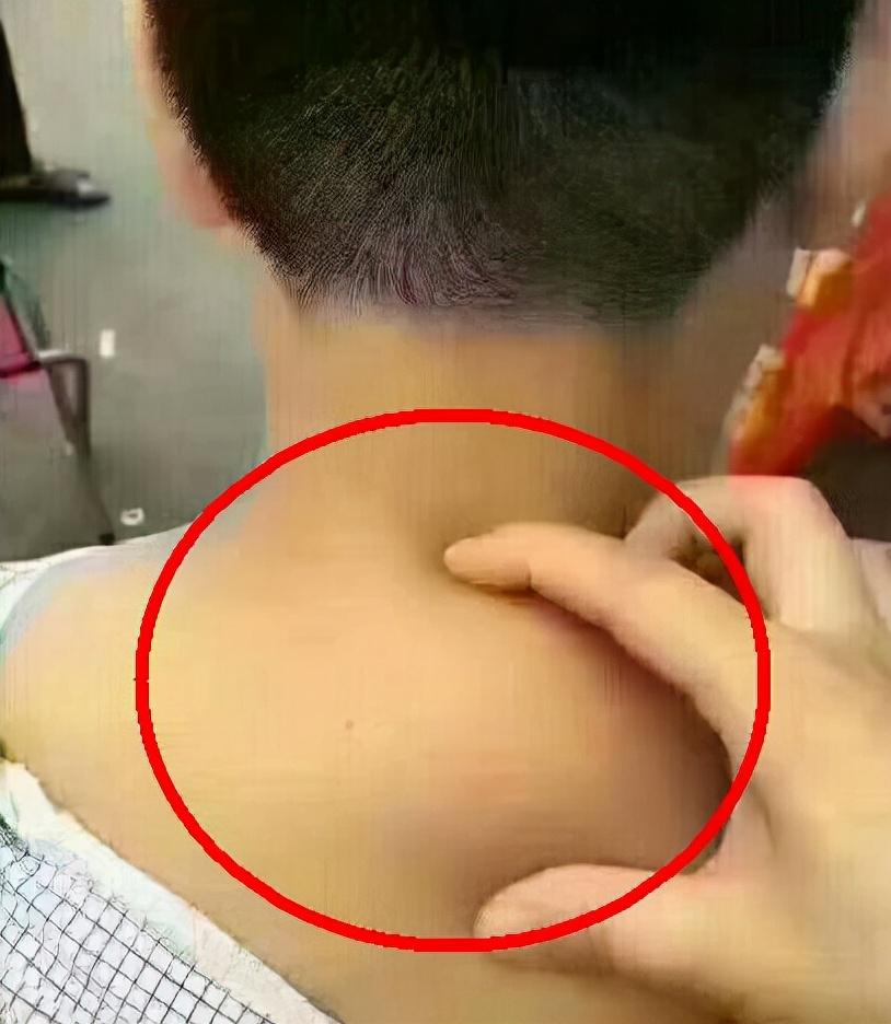 背部吸脂手术，重塑身材的革新方法