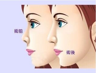 假体隆鼻术的费用分析