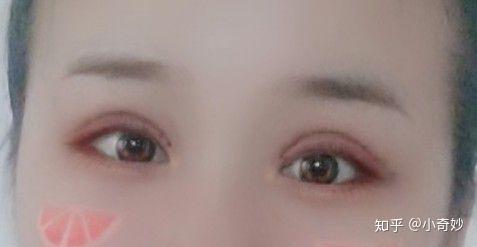 双眼皮全切手术，重塑眼部魅力的最佳选择