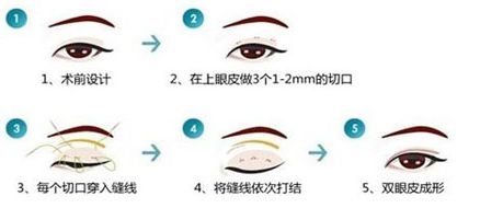 眼部整形手术费用