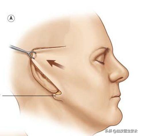 面部拉皮除皱价格，深度解析与理解