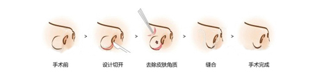 鼻头鼻翼缩小术价格详解，了解手术费用及其相关因素