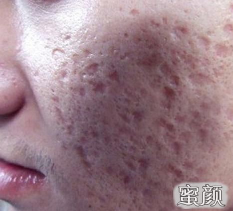 激光去除痘坑的费用分析