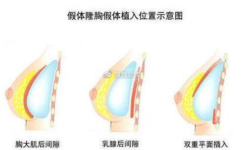 丰胸手术的价格及其相关因素探讨