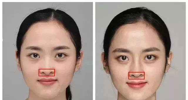 鼻翼修复手术，重塑自信的鼻型之美