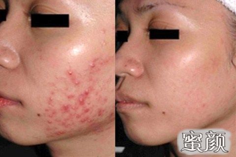 激光祛痘需要多少钱，全面解析费用因素与注意事项