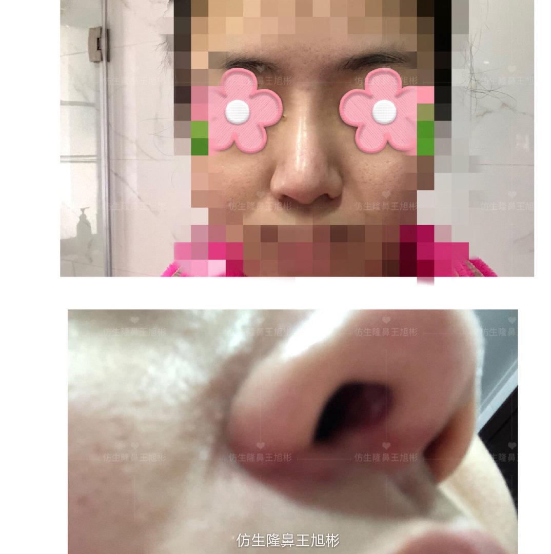 鼻头缩小手术费用详解，价格、因素与选择