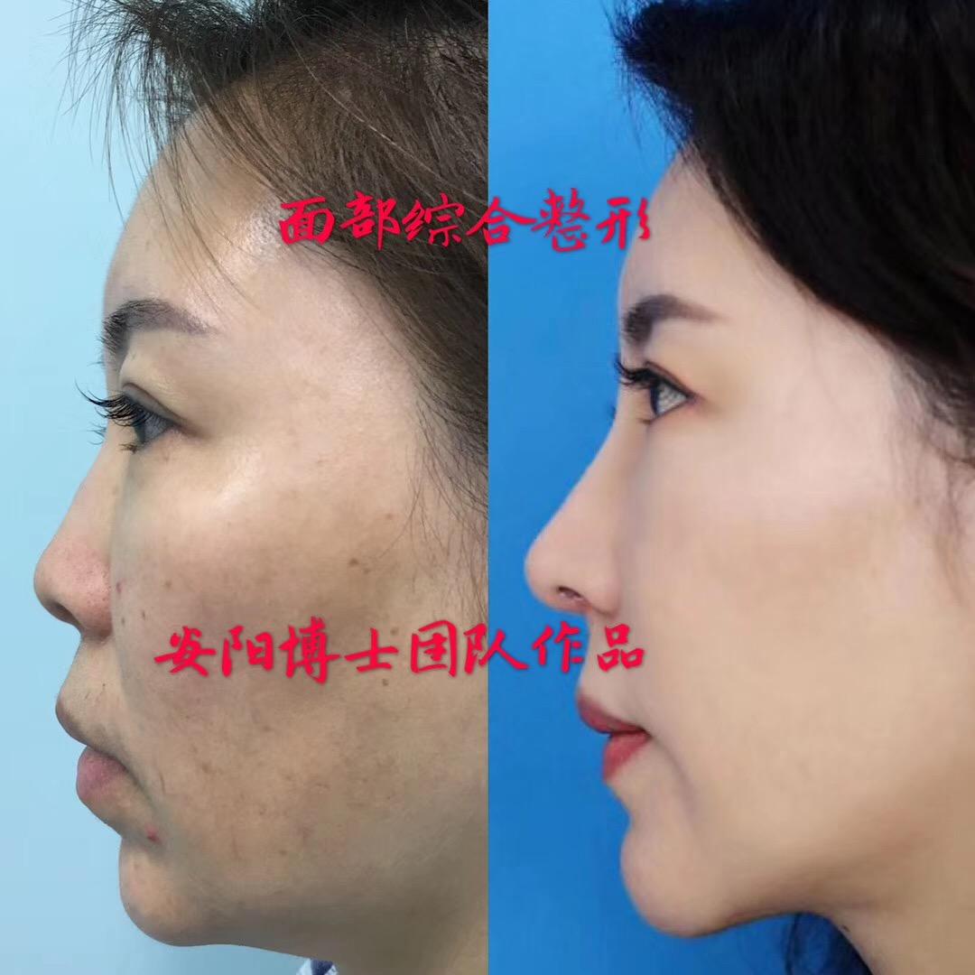 整鼻手术，重塑自信的面部焦点