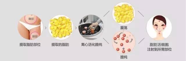 自体脂肪填充，重塑美丽的秘密武器