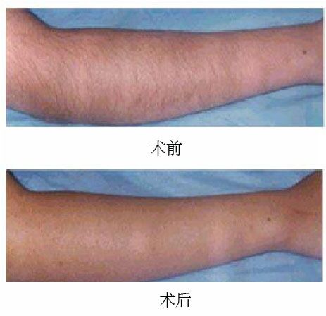 复合彩光脱毛，现代脱毛技术的革新之选